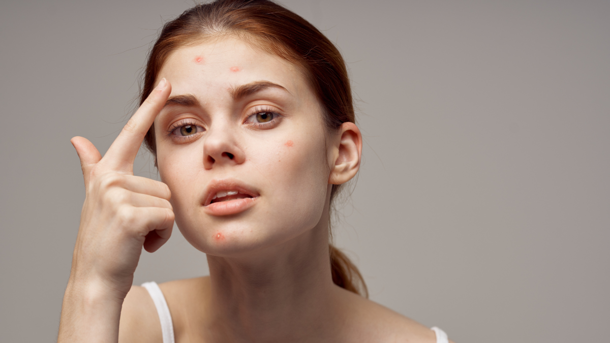 how-to-get-rid-of-dry-skin-caused-by-harsh-acne-treatments